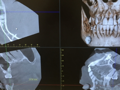 歯科用CT