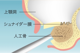 ソケットリフト(上顎洞底挙上術)